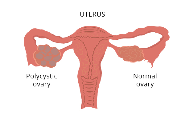 difference between normal and polycystic ovaries